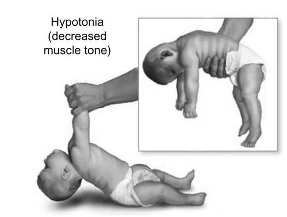 Medical illustration of a baby with hypotonia, demonstrating decreased muscle tone in lying and upright positions—educational graphic for infant health awareness.